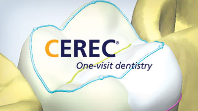 cerec dentists one visit crowns