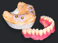 implant supported dentures